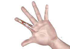 Flexor Tendon Injuries